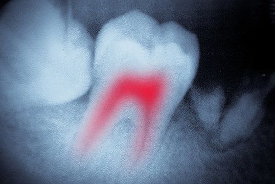 Illustrated x-ray image showing an infected tooth