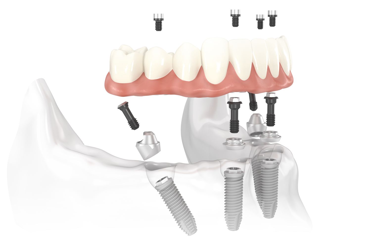 Illustration of an implant-supported denture.