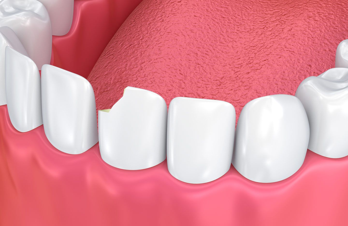 A chipped tooth in need of dental bonding.
