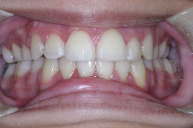 Case 1 after orthodontic procedure